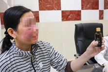 Nhiều người nhập viện do dùng 'mỹ phẩm trắng da' không rõ nguồn gốc